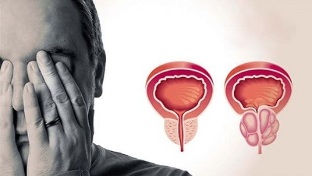 causas de prostatite em homens