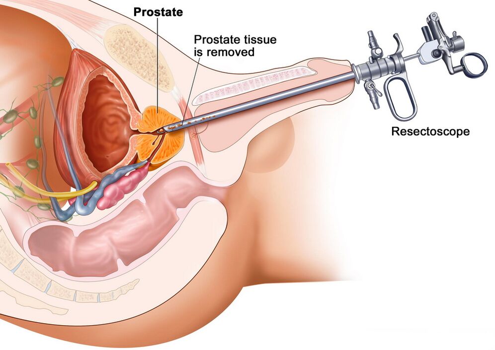 Coleta de tecido prostático para diagnóstico preciso de prostatite